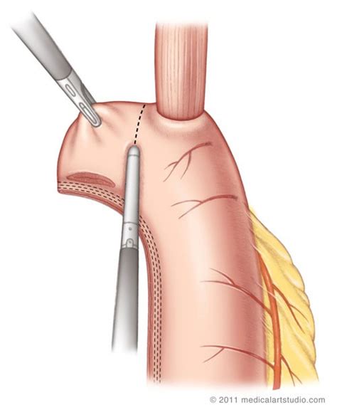 esophagus surgery
